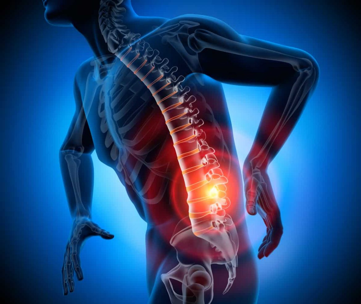 Starke Rückenschmerzen können auf einen Bandscheibenvorfall hindeuten